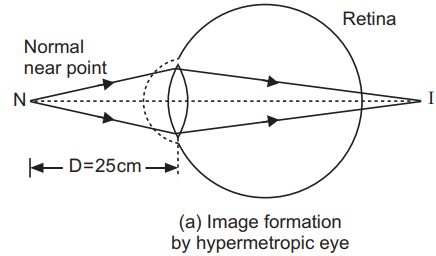 (a) Image formation by hypermetropic eye