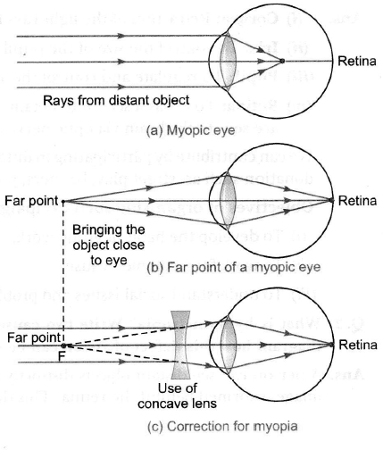 myopia diagram class 10