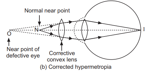 Diagram of Corrected hypermetropia