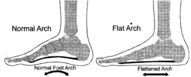 Mention the causes and corrective measures for the Flat Foot - Sarthaks ...